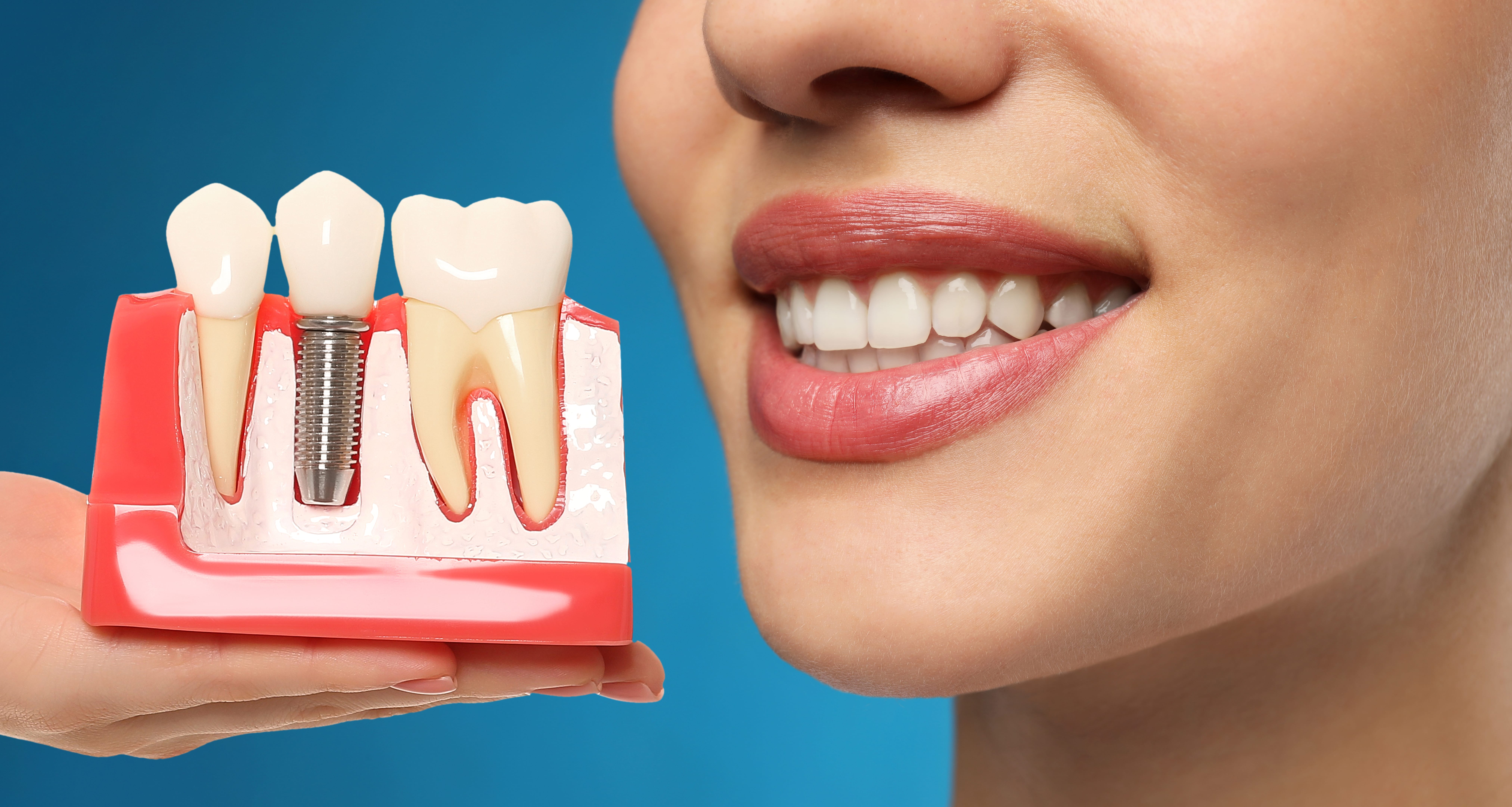 Dental Implants Dental Implants