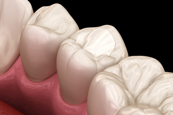 How Long Do Composite Fillings Last?